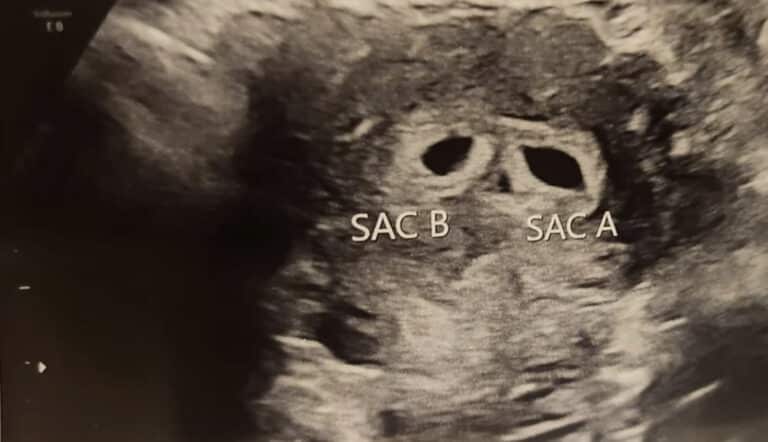 Two sacs as seen in early pregnancy sonogram